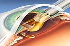 Shanti Saroj Hospital Services - Cataract Extraction